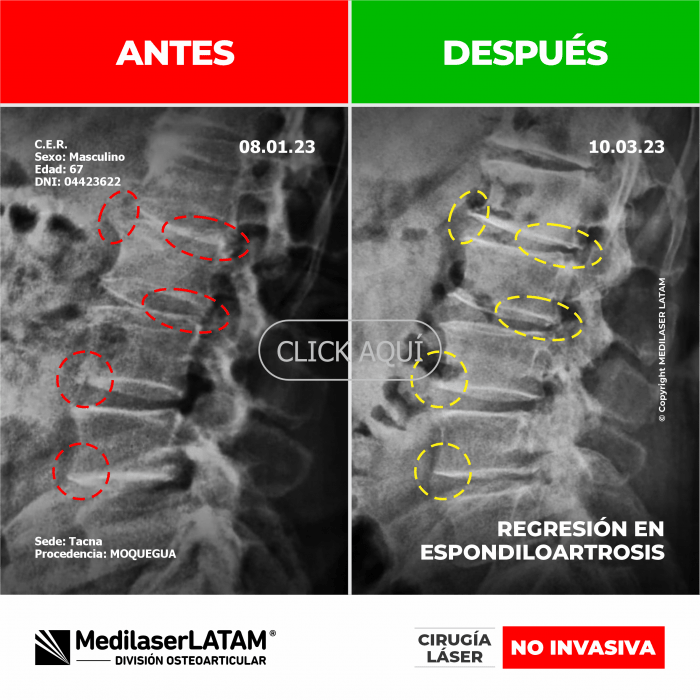Evidencia en Espondiloartrosis – Casimiro Espinal Radiografías seriadas prueban regresión de degeneración vertebral múltiple.