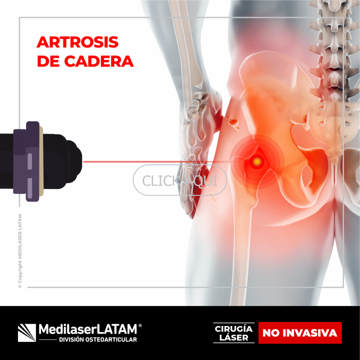 Artrosis de cadera: tratamiento láser para aliviar dolor y recuperar movilidad. 90% efectividad sin cirugía.