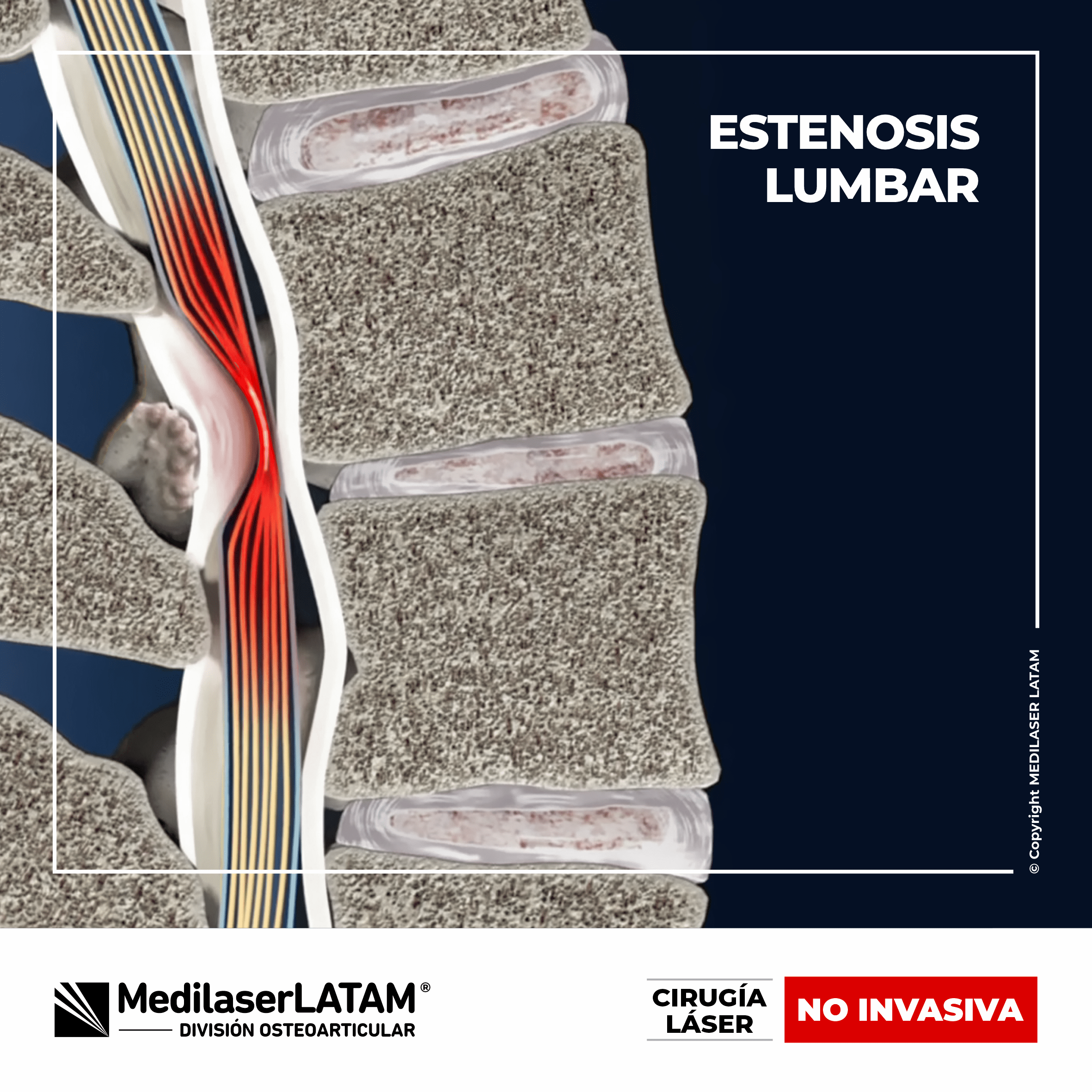 Estenosis lumbar: tratamiento láser para aliviar compresión nerviosa. 90% de efectividad comprobada. Sin cirugías invasivas.