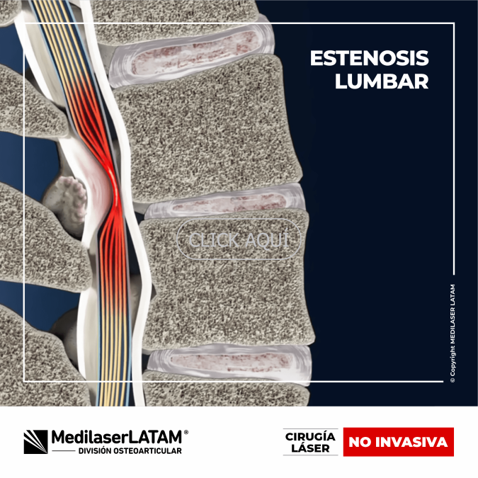 Estenosis lumbar: tratamiento láser para aliviar compresión nerviosa. 90% de efectividad comprobada. Sin cirugías invasivas.