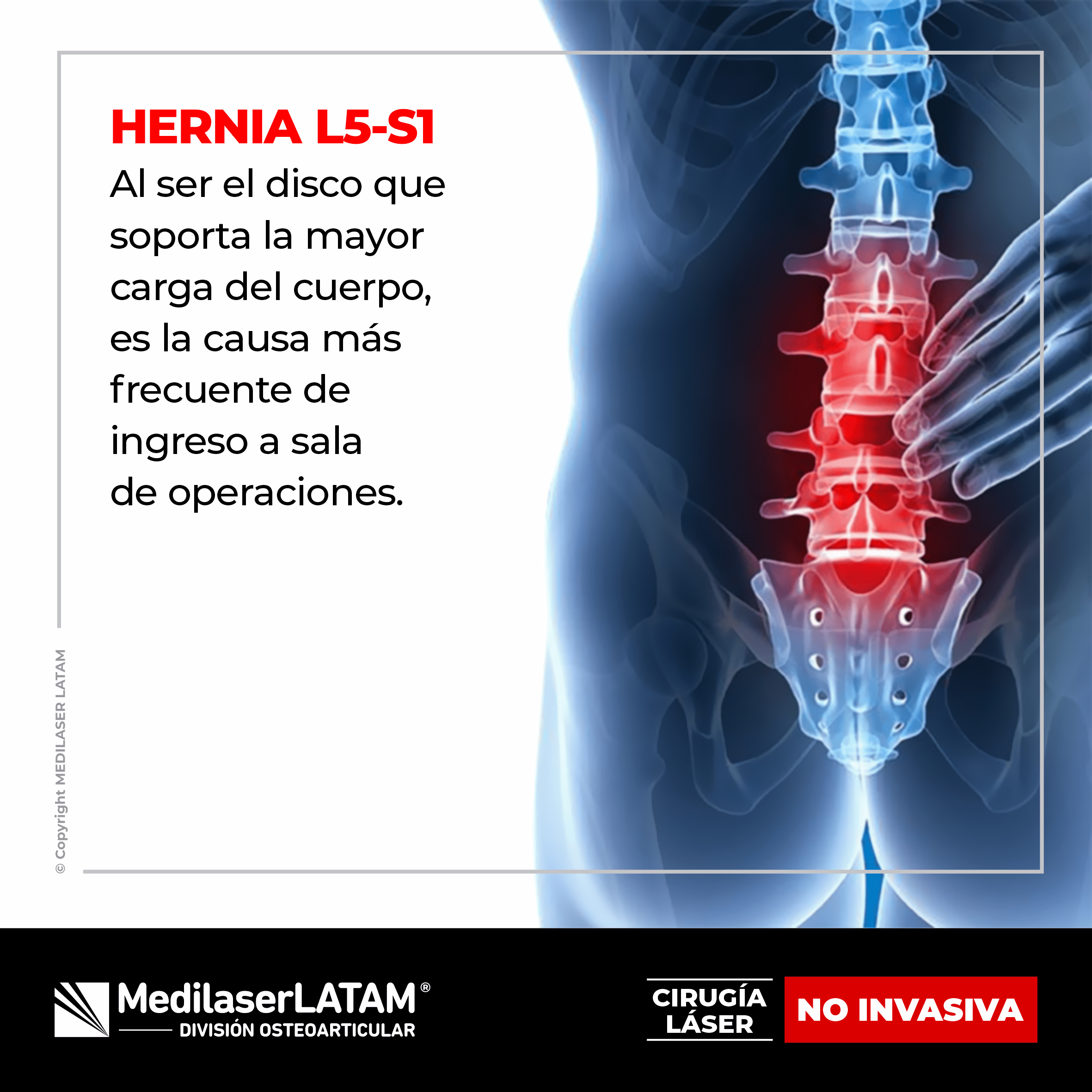 Hernia L5-S1: Tratamiento láser no invasivo que alivia el dolor sin cirugía. Postula para evaluar si eres candidato para una cirugía láser no invasiva en Medilaser LATAM.