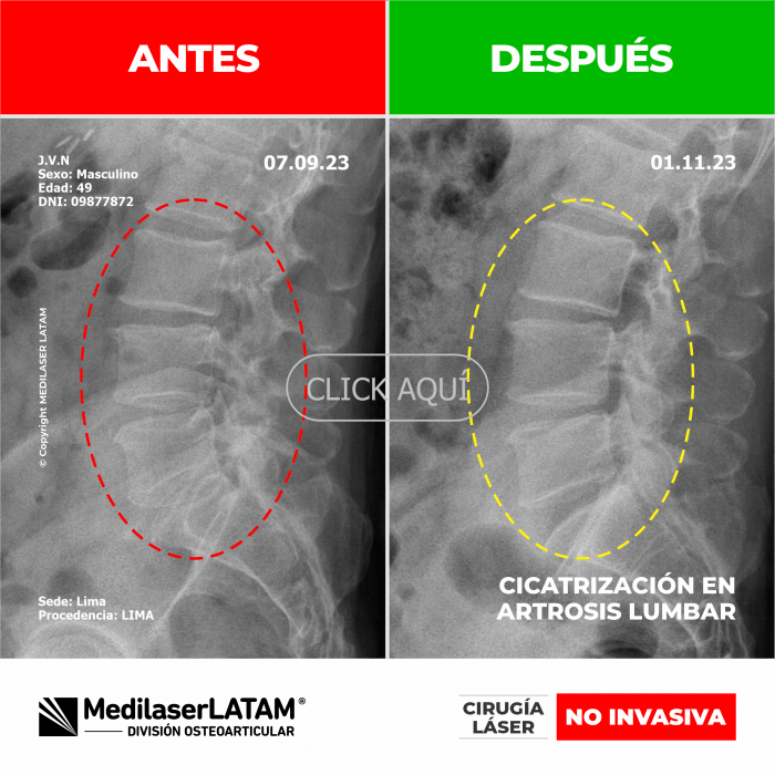 Evidencia en Artrosis Lumbar – Luz Marca Estudio imagenológico que evidencia cicatrización vertebral en lumbalgia crónica