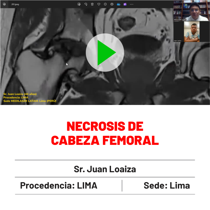 Testimonio de Juan Loaiza: Necrosis de cadera revertida sin prótesis. Experiencia verificada por especialistas.