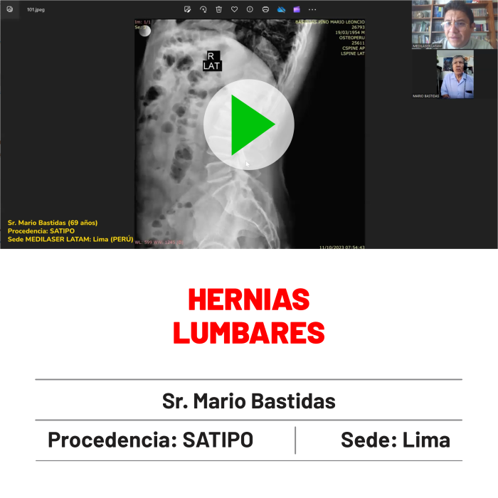 Testimonio de Mario Bastidas: Hernias lumbares tratadas con éxito. Técnica avanzada sin hospitalización.