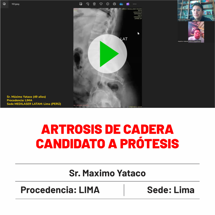 Testimonio de Máximo Yataco: Artrosis de cadera candidato a prótesis evitó cirugía mayor. Experiencia verificada.