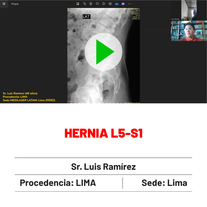 Testimonio de Luis Ramírez: Hernia L5-S1 tratada sin cirugía abierta. Recuperación rápida y sin complicaciones.