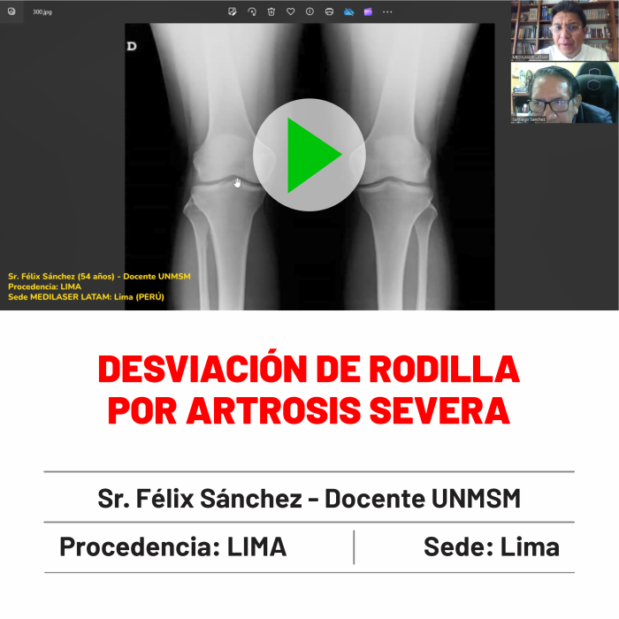 Testimonio de Feliz Sánchez: "Desviación de rodilla por artrosis severa corregida. Caso documentado con antes/después impresionantes.