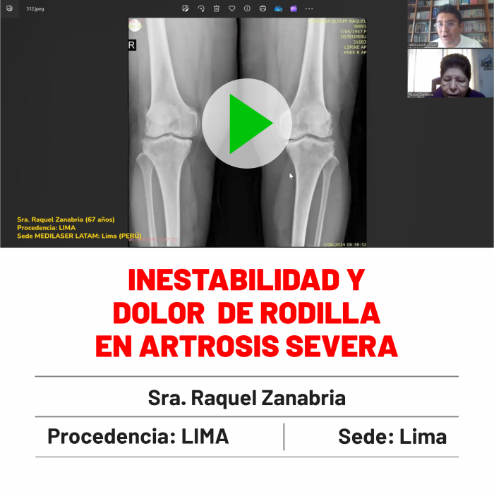 Testimonio de Raquel Zanabria: Inestabilidad y dolor por artrosis severa de rodilla solucionados. Caso documentado paso a paso.