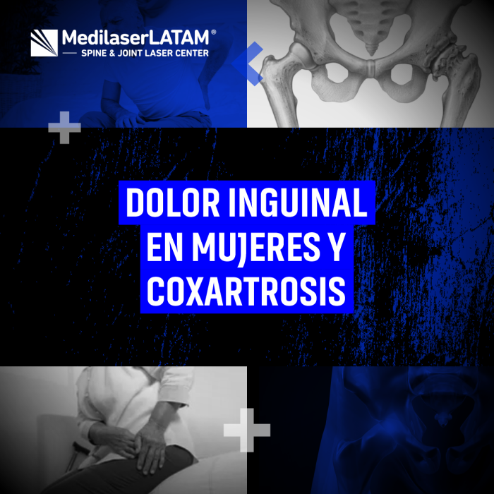 Dolor inguinal en mujeres: ¿es artrosis de cadera? Tratamientos para coxartrosis con enfoque en anatomía femenina. Alivio comprobado.