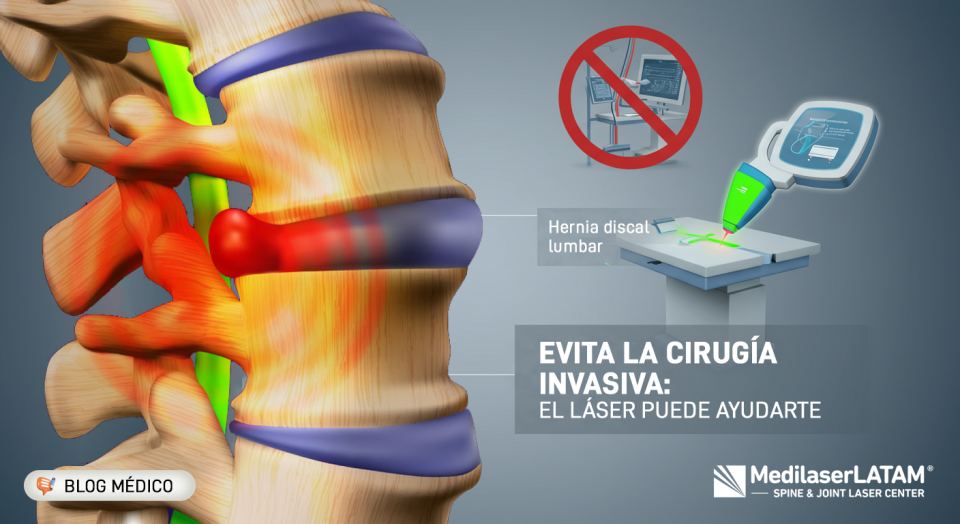 Hernia discal: síntomas, causas y tratamientos no quirúrgicos. El láser médico alivia el dolor sin cirugía. ¡Descubre más!