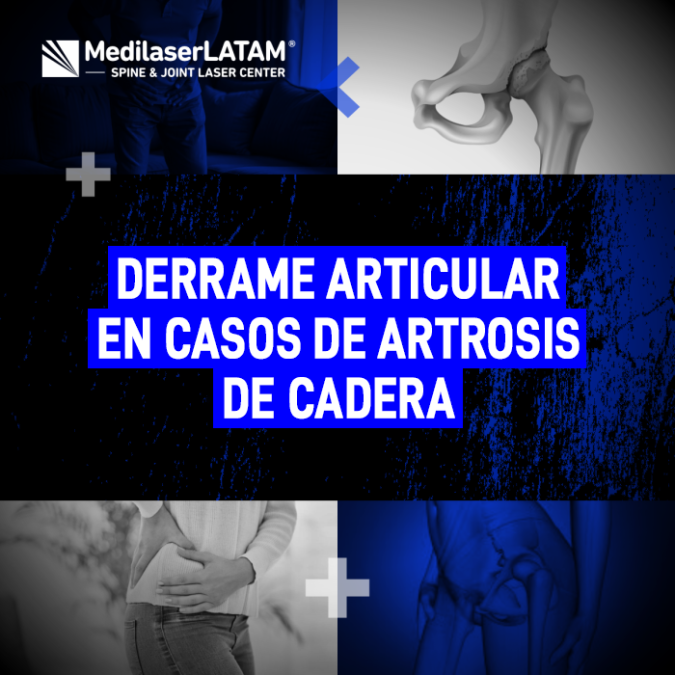 No ignores el derrame articular. Aprende por qué es una señal de alarma en la artrosis de cadera y cuándo buscar atención médica urgente.