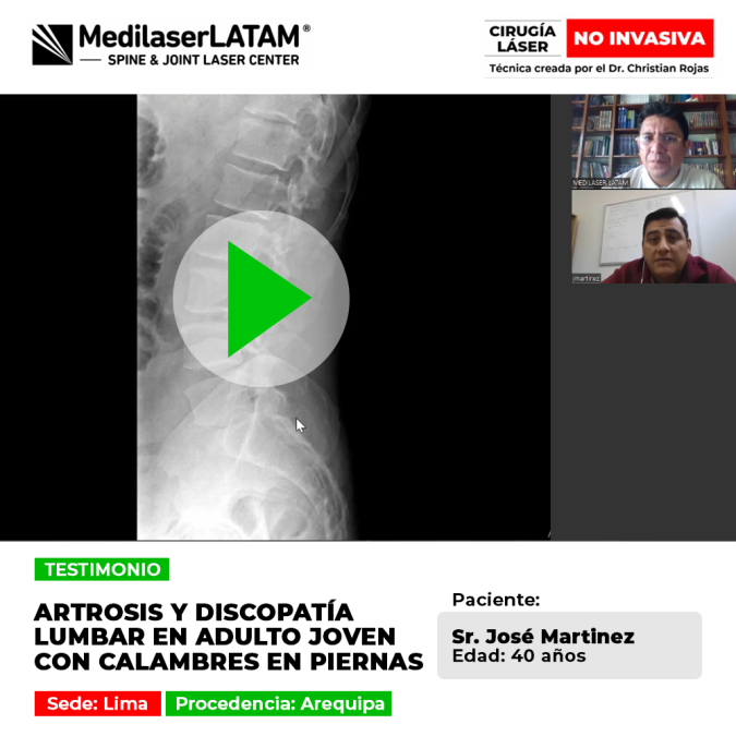 Testimonio de José Martínez: Cirugía láser no invasiva para Artrosis y discopatía lumbar en adulto joven con calambres en piernas