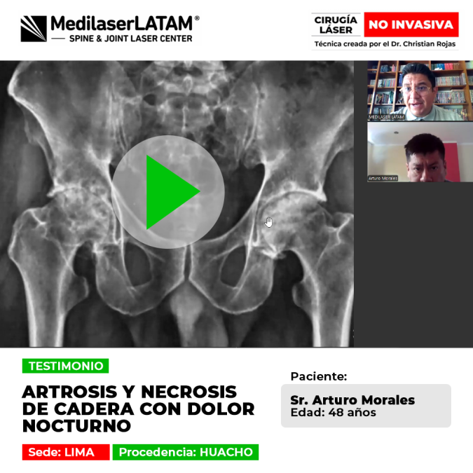 Arturo Morales relata su lucha contra la artrosis y necrosis de cadera, que le causaban dolor nocturno. Se recuperó con tratamiento láser.