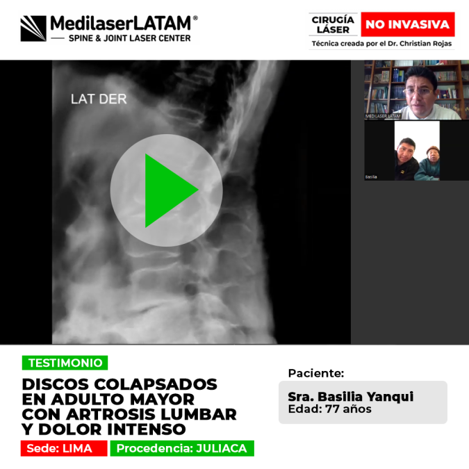 Testimonio de Basilia Yanqui (Juliaca) sobre sus discos colapsados y artrosis lumbar. Vea cómo logró alivio del dolor intenso con cirugía láser.