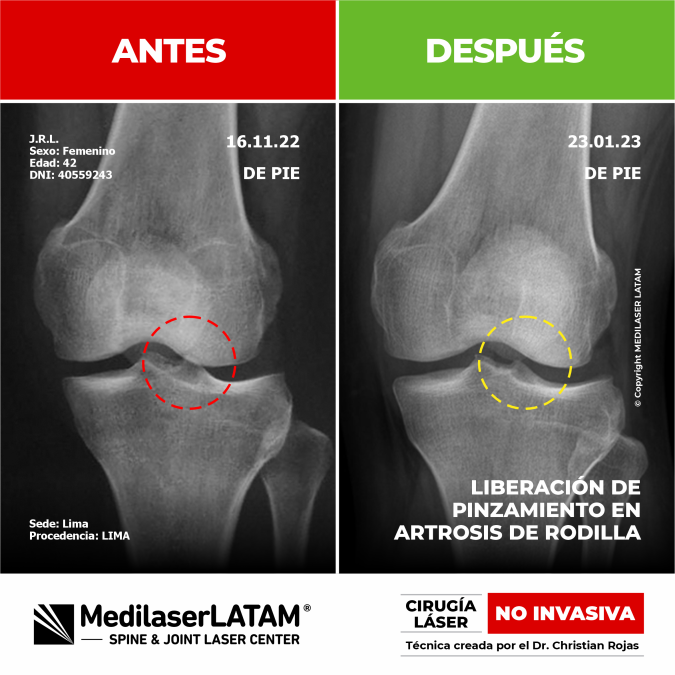 Documentación de la regresión de gonartrosis en Julia Ramírez. Resultados visibles con el tratamiento láser NO INVASIVO del Dr. Christian Rojas.