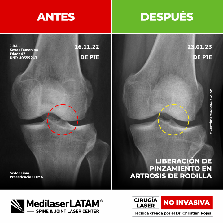 Documentación de la regresión de gonartrosis en Julia Ramírez. Resultados visibles con el tratamiento láser NO INVASIVO del Dr. Christian Rojas.