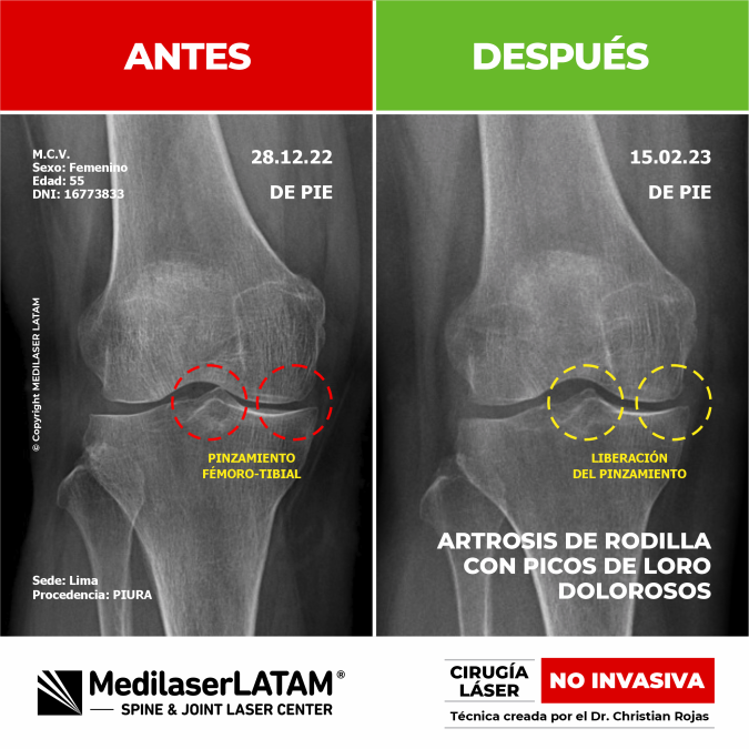 Artrosis en rodilla derecha en Maritza Castro. Conozca el tratamiento efectivo y NO INVASIVO del Dr. Christian Rojas.