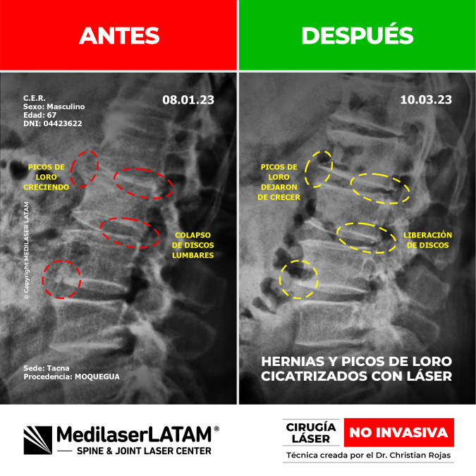 Hernias y picos de loro en Asimiro Espinal. Resultados comprobados con la Cirugía Láser NO INVASIVA.