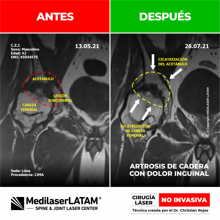 regresión de coxartrosis en José Cruz. Conozca el antes y después en la articulación de la cadera con Cirugía Láser NO INVASIVA.