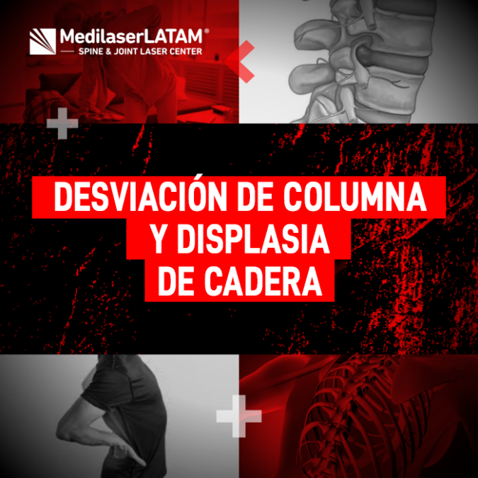 Desviación columna cadera: ¿Cómo se relacionan? El Dr. Rojas explica la conexión entre ambas condiciones y cómo tratarlas con láser.