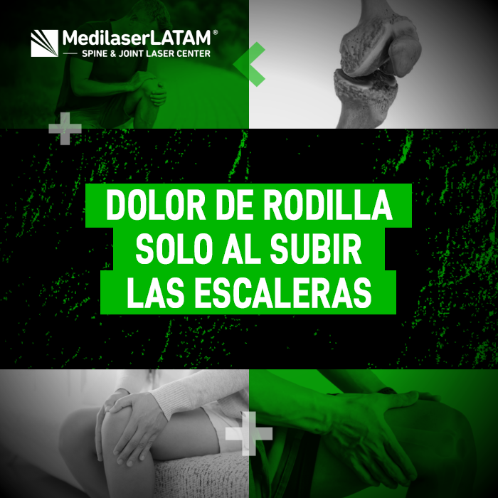 Dolor rodilla escaleras: El Dr. Rojas explica la señal de alarma que indica daño articular y cómo la cirugía láser actúa para frenar el desgaste.