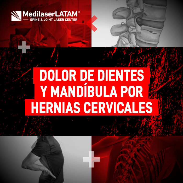 Dolor de dientes y mandíbula: descubre cómo las hernias cervicales afectan tu rostro y cómo el tratamiento láser alivia estos síntomas sin cirugía.
