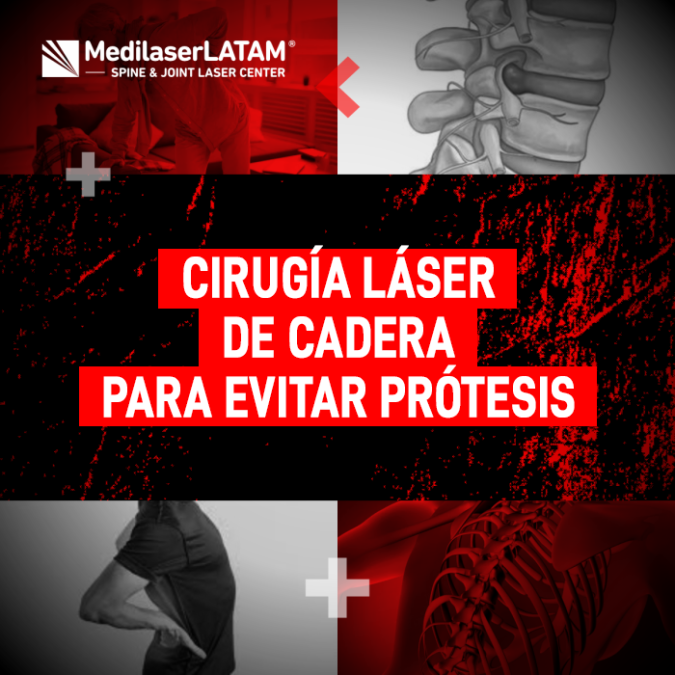 Cirugía láser de cadera: una alternativa real para evitar la prótesis. Conoce los tiempos de recuperación y cómo soldar el cartílago sin cortes.