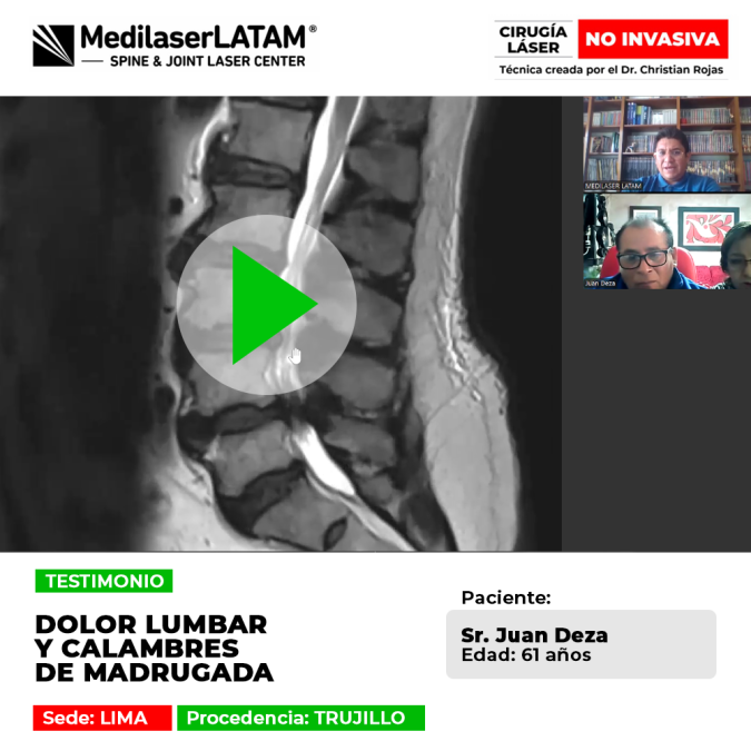Dolor lumbar y calambres de madrugada tratados con éxito. Descubre cómo nuestro tratamiento láser ayuda a recuperar la movilidad sin cirugías.