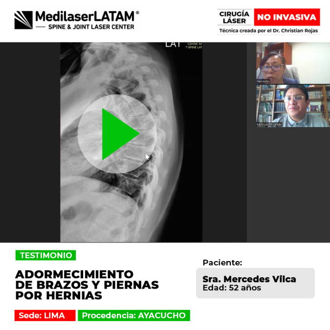 Adormecimiento de brazos y piernas por hernias tratado con éxito. Conoce cómo nuestro tratamiento láser ayuda a recuperar tu calidad de vida.