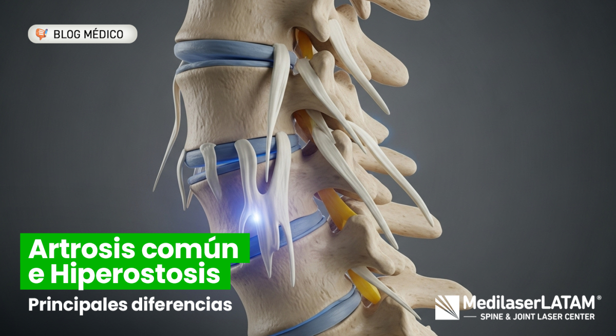 ¿Es artrosis o enfermedad de DISH? Descubre por qué se calcifica la columna y cómo detener la rigidez sin recurrir a cirugías invasivas.