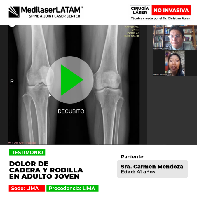 Dolor de Cadera y Rodilla: descubre cómo nuestra técnica de láser médico logra regenerar el cartílago y evitar el uso de prótesis en pacientes jóvenes con desgaste articular.