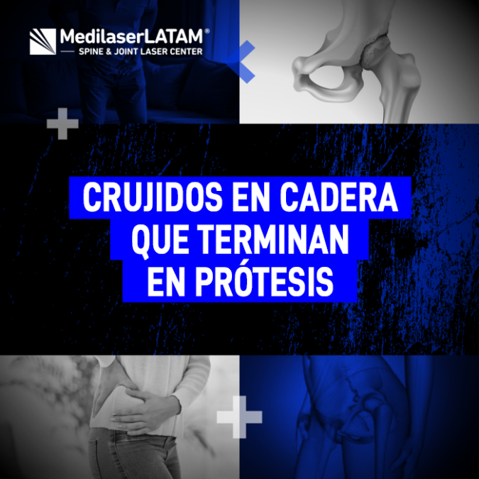 Los crujidos en la cadera pueden ser una señal de desgaste severo. Descubre cómo evitar una cirugía de prótesis con alternativas avanzadas.