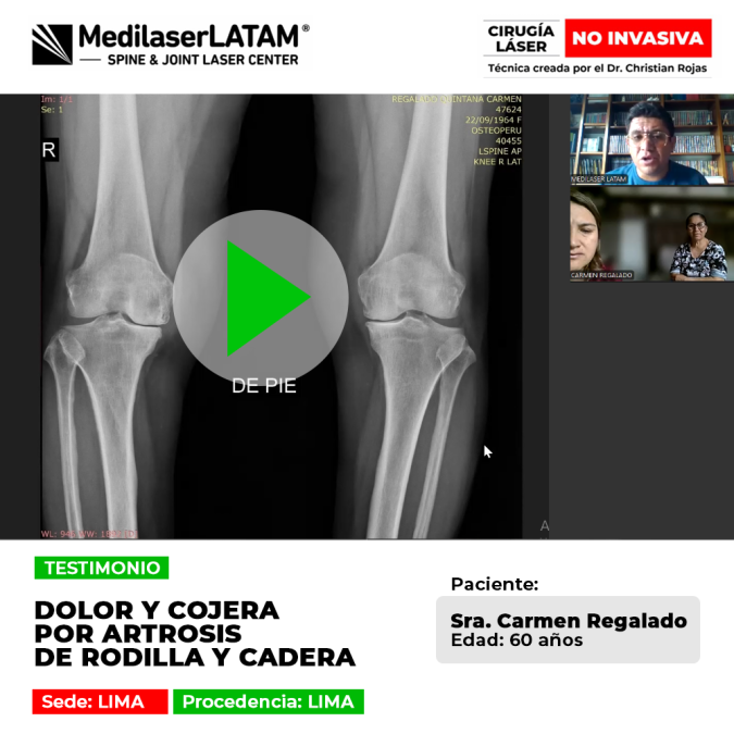 Paciente supera la cojera y el dolor crónico causado por Artrosis de rodilla y cadera. Descubre cómo volver a caminar con tratamiento láser.