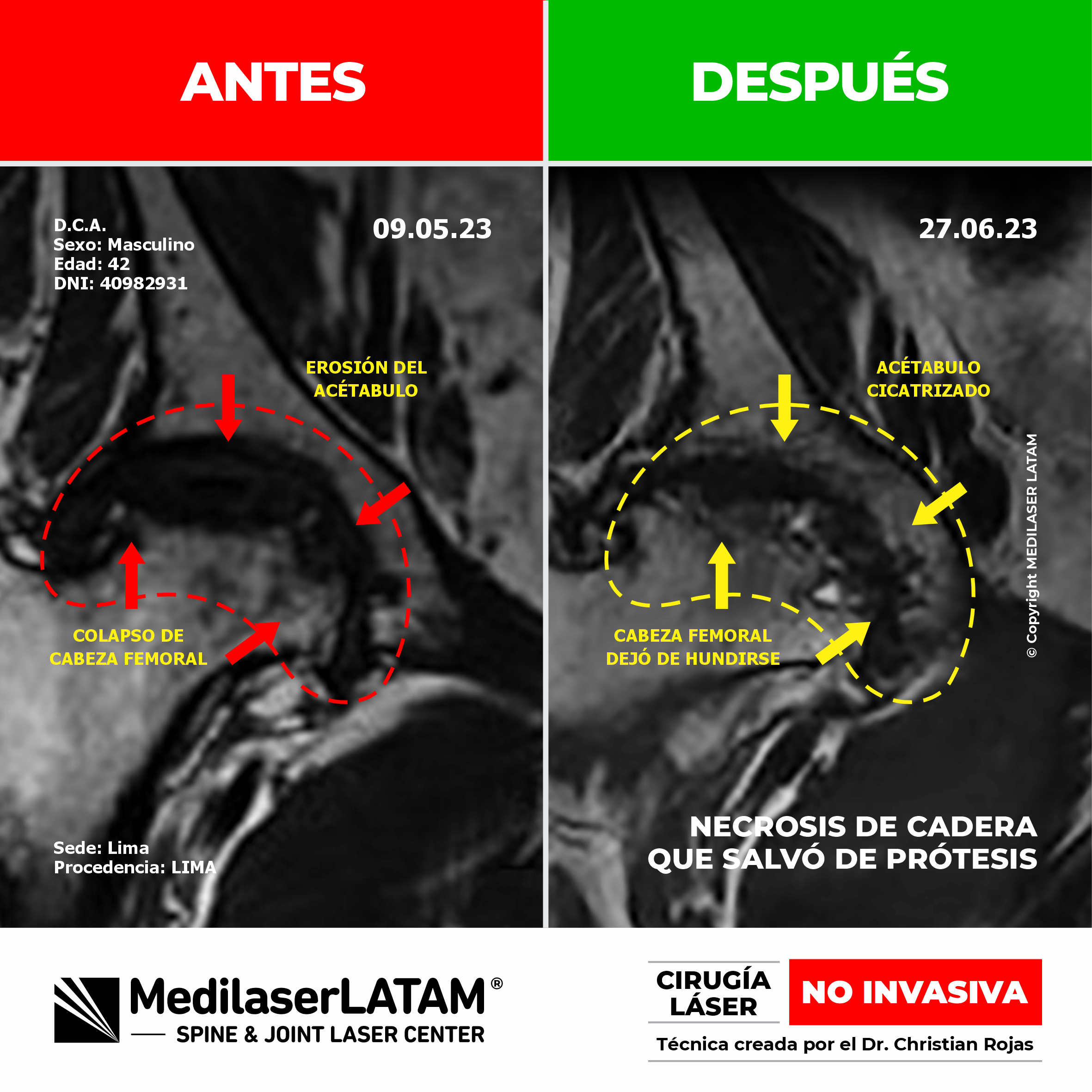 Necrosis de cadera: evidencia científica de reparación del tejido óseo con láser, evitando el reemplazo total de la articulación.
