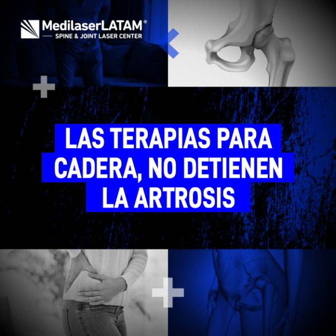 Artrosis de cadera: descubre por qué las terapias convencionales no frenan el desgaste y conoce la alternativa médica para detenerlo.