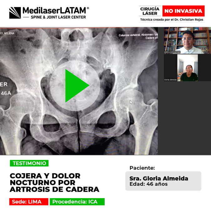 Cojera y Dolor Nocturno: paciente de Ica recupera su movilidad tras tratar la Artrosis de Cadera con tecnología láser avanzada.