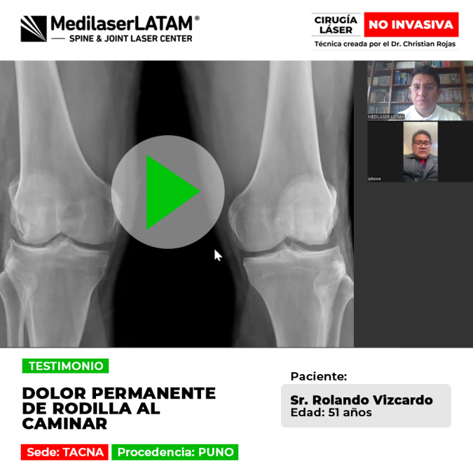 Dolor permanente de rodilla al caminar: paciente de Puno recupera su calidad de vida tras tratar el desgaste articular con tecnología láser.