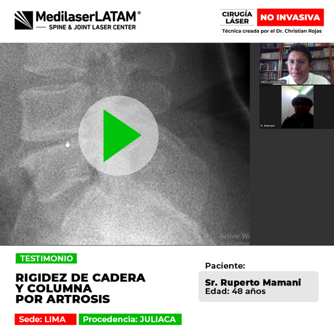 Rigidez de cadera y columna por Artrosis: conoce cómo la tecnología médica avanzada devolvió la flexibilidad a un paciente de Juliaca.