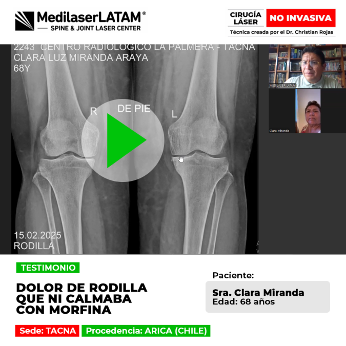 Dolor de rodilla que ni calmaba con morfina: paciente de Arica recupera su vida tras tratar el desgaste severo con tecnología láser única.
