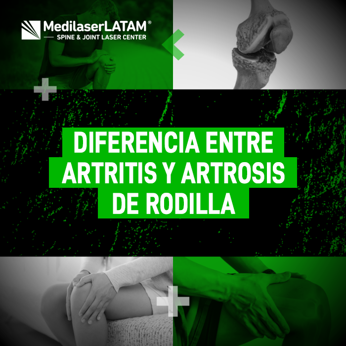 Entiende los factores que diferencian la artritis de la artrosis de rodilla para obtener un diagnóstico correcto y un mejor cuidado.