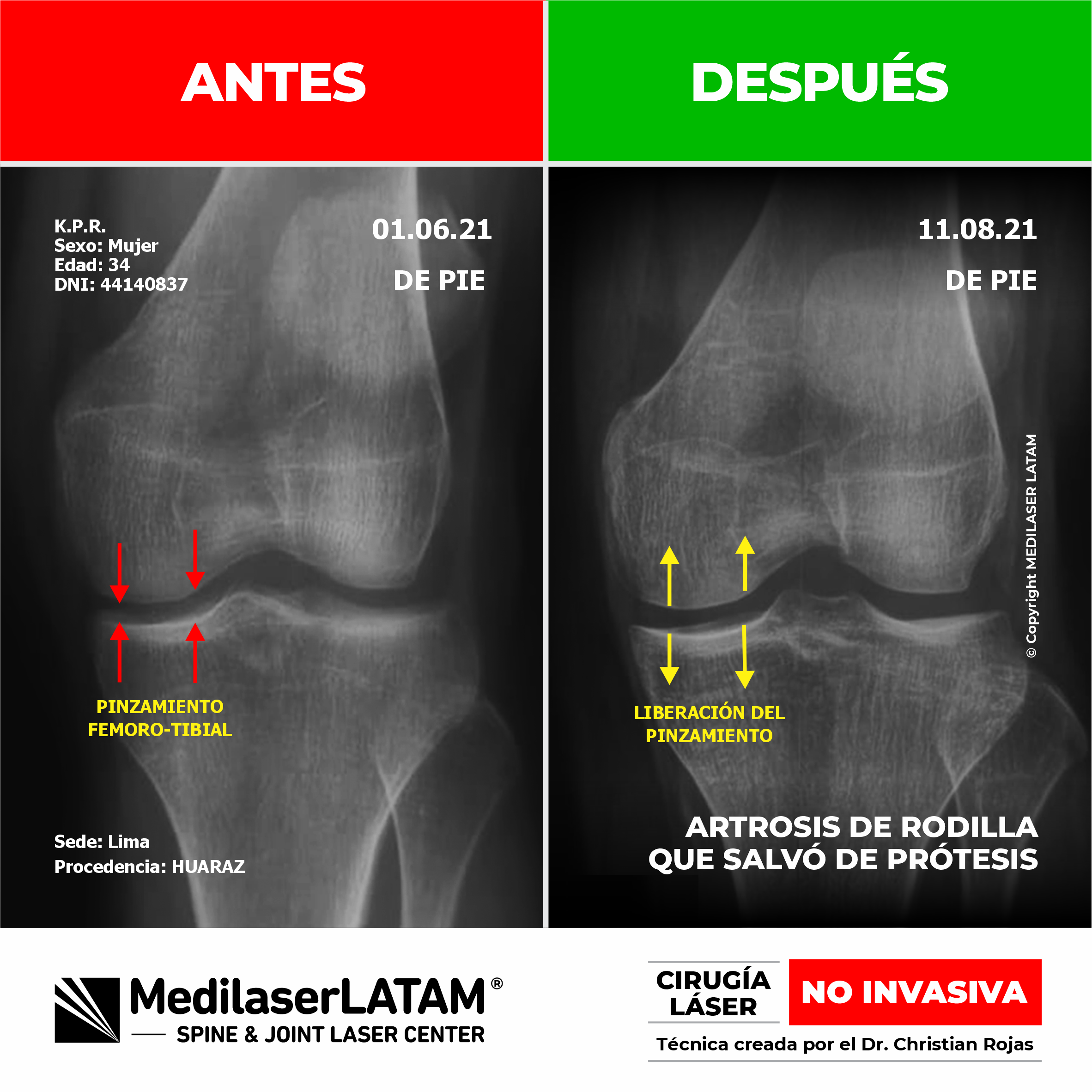 Radiografía de antes y después en desgaste severo de rodilla. Tratamiento médico láser que demostró evitar de forma efectiva la prótesis.