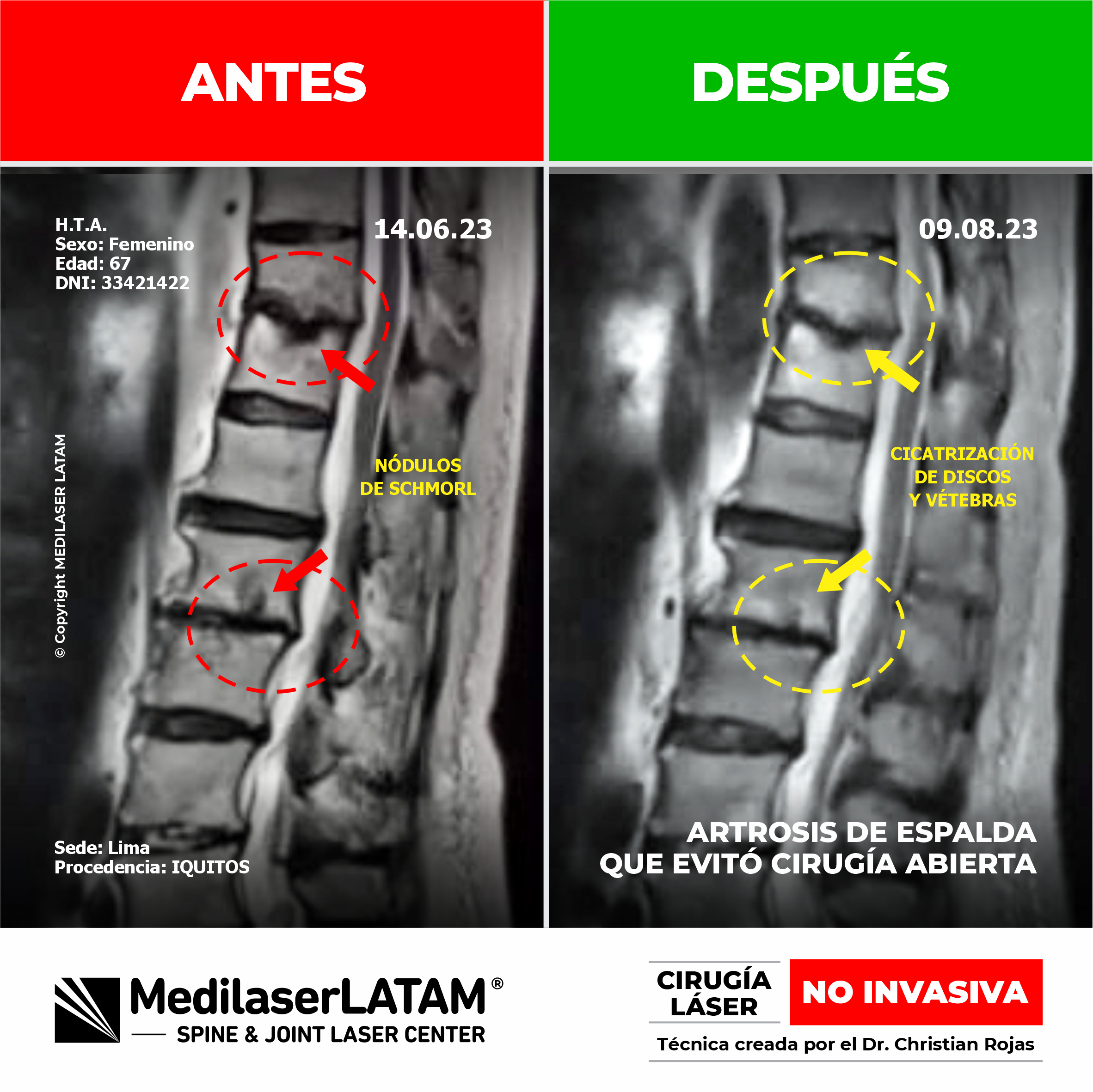 Evidencia clínica de regresión en artrosis de columna. Tratamiento avanzado y NO INVASIVO para la regeneración y descompresión articular.