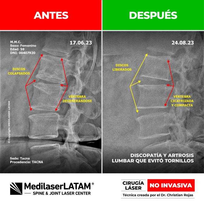 Documentación de la regresión en artrosis lumbar. Reducción del dolor de espalda baja con el tratamiento médico láser NO INVASIVO.
