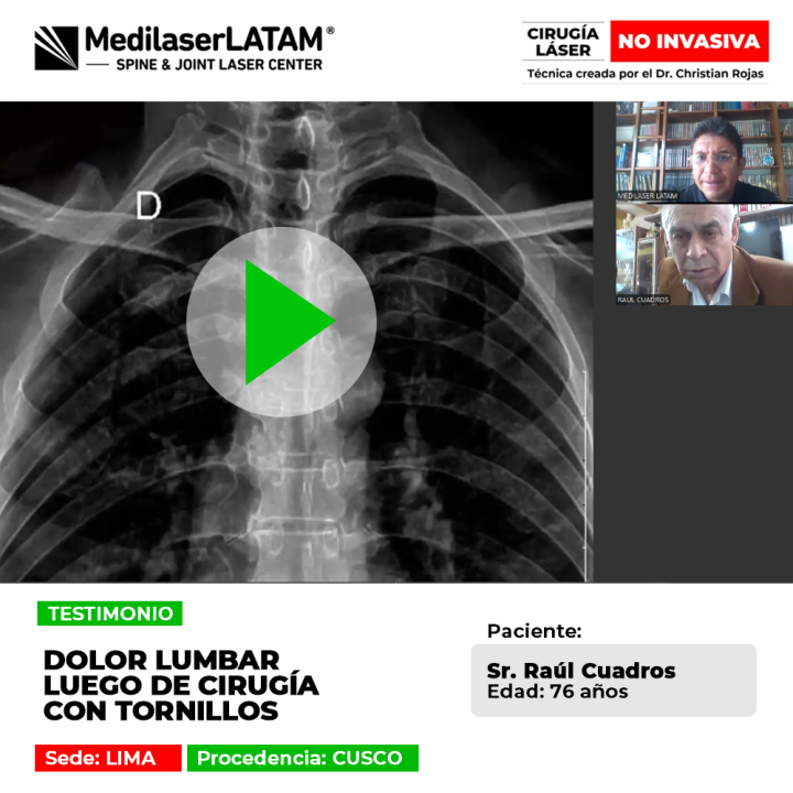 Entérate de la historia del paciente que sufría un severo dolor lumbar tras una operación de columna y cómo halló una alternativa efectiva.