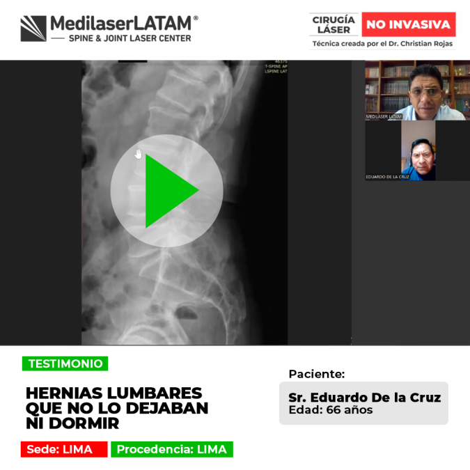 Las hernias lumbares agudas causan intensos dolores que impiden conciliar el sueño. Conoce procedimientos médicos para el alivio.