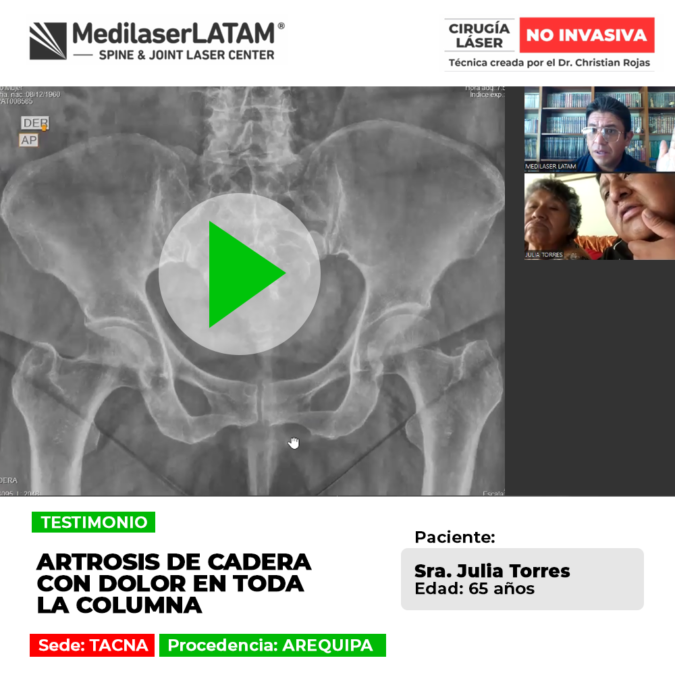 La artrosis de cadera puede irradiar tensión y dolor a lo largo de la columna. Infórmate sobre procedimientos médicos para su control.
