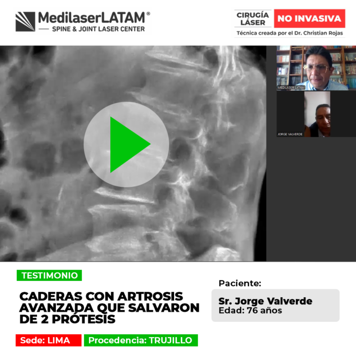 Las caderas con artrosis avanzada pueden recuperarse evitando prótesis. Conoce alternativas médicas seguras para volver a caminar bien.