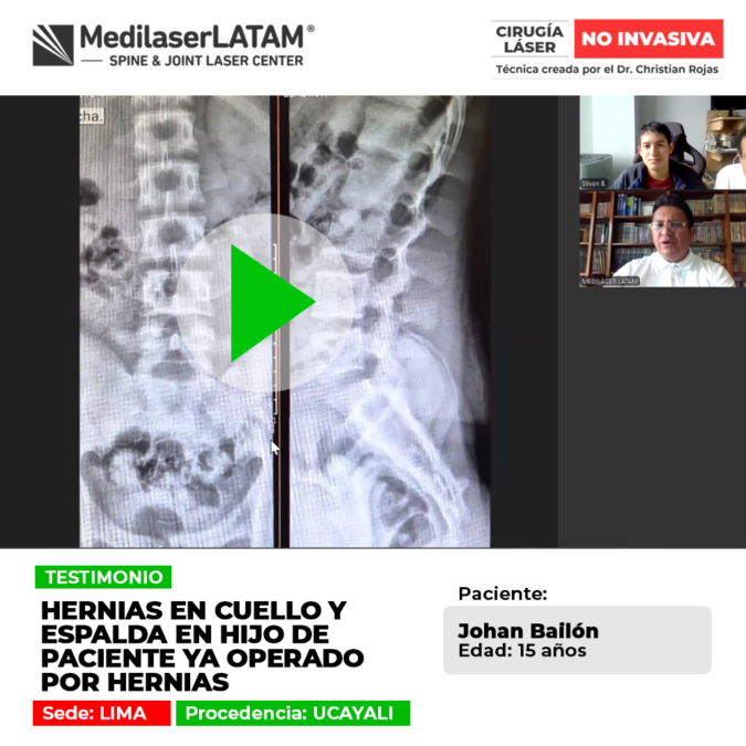 Las hernias en cuello y espalda afectan a jóvenes y adultos. Descubre cómo tratar los discos dañados y evitar operaciones complejas.