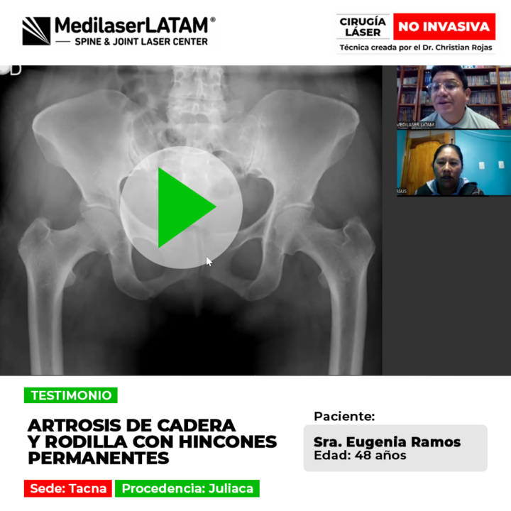 La artrosis de cadera y rodilla genera hincones punzantes continuos. Descubre opciones médicas efectivas para frenar el daño articular.