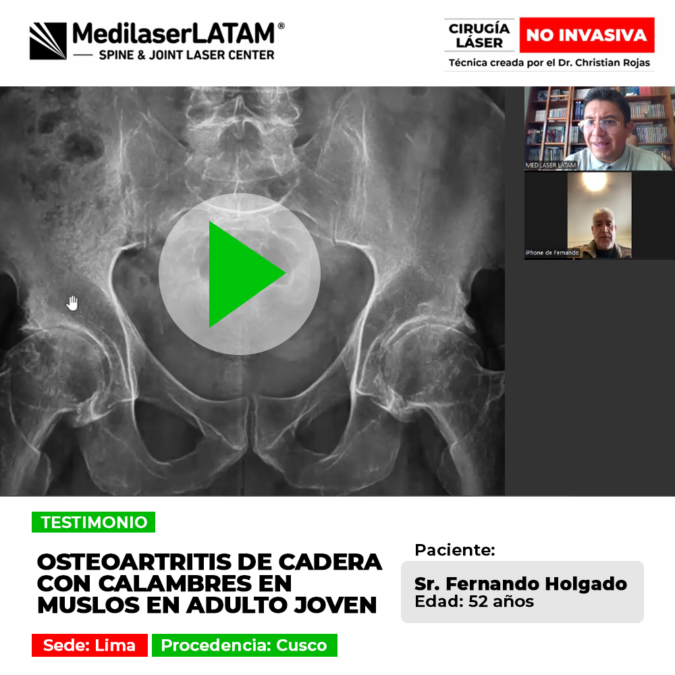 La osteoartritis cadera provoca dolor articular y molestos calambres musculares. Conoce alternativas médicas seguras para su alivio.